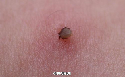 小伙腹泻两周竟感染鬼脸虫，揭秘病例背后的真相