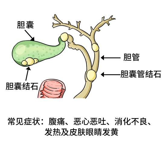 网络直播现象下的健康风险，吃播与胆结石的关联探究